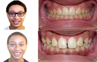 before and after braces