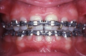 Braces in 1980s