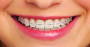 clarity clear braces