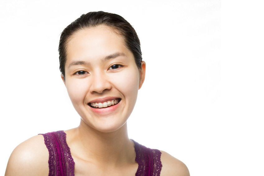 woman wearing teeth retainer