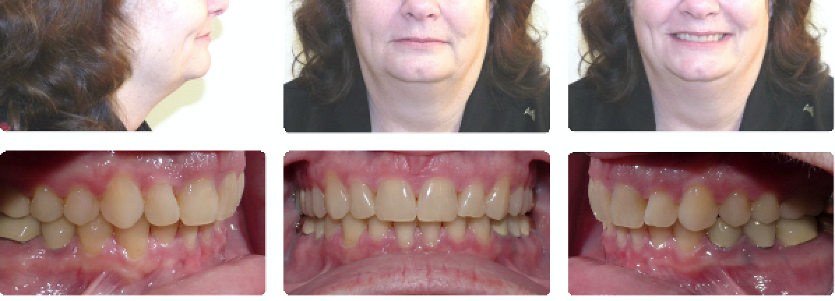 Results of overbite orthodontic treament on adult woman