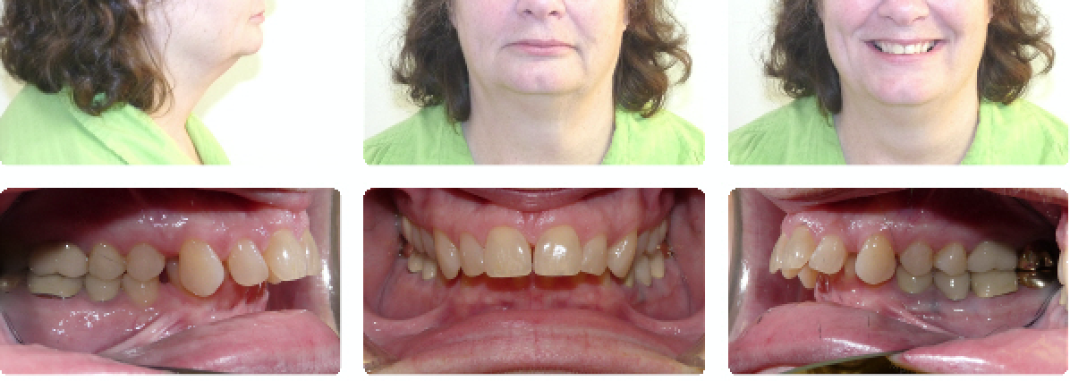 Image of overbite in adult woman before orthodontic treatment